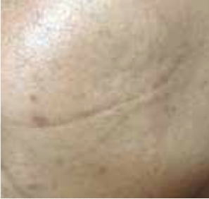 Scar After Treatment